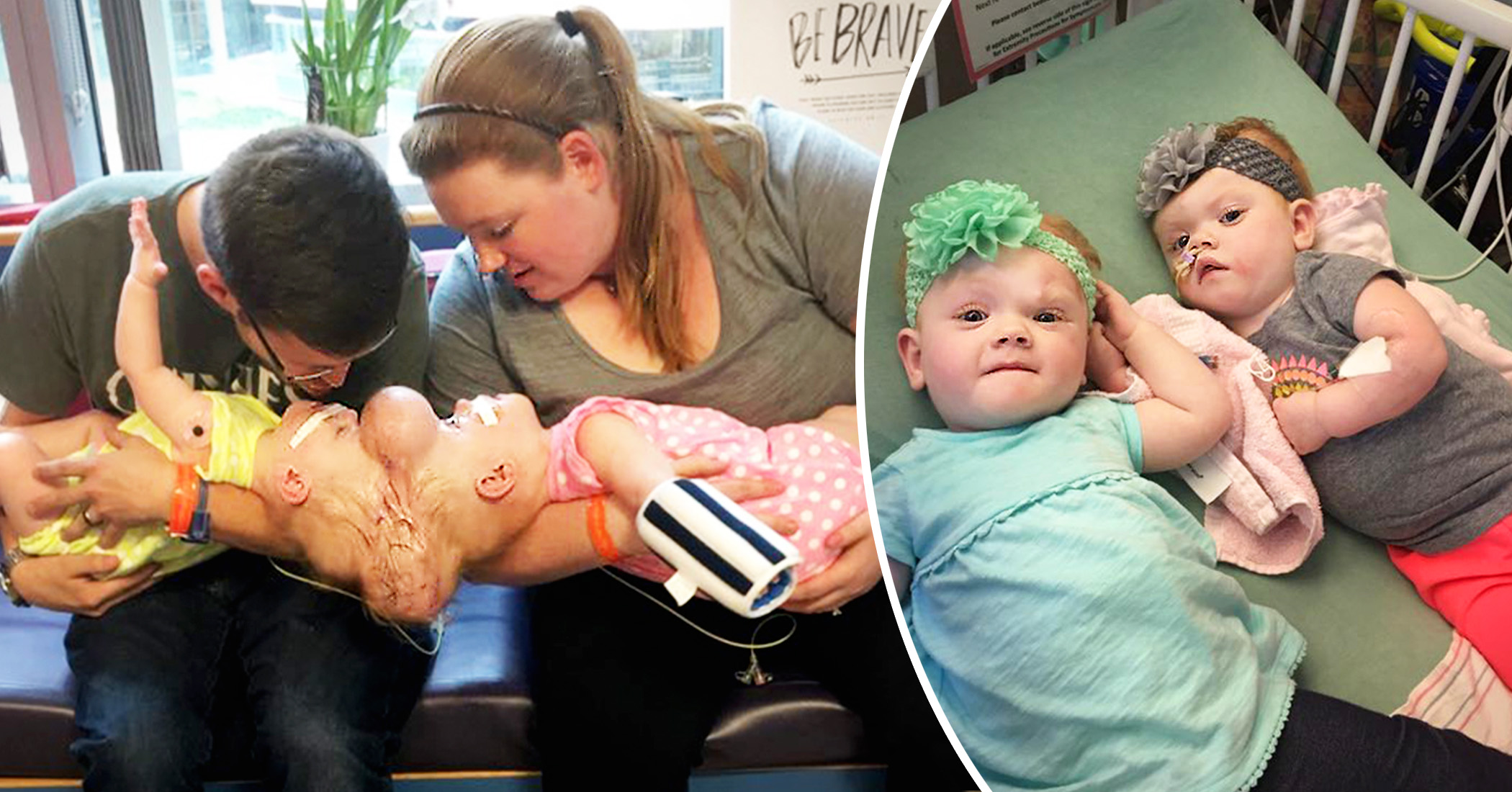 Twins Conjoined at Head Survived Separation, Are Now 4, Thriving ...