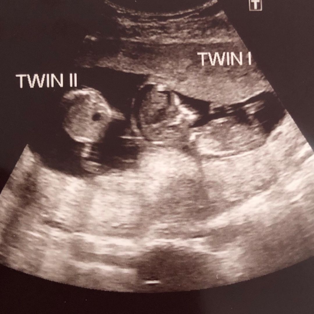 Mom Delivers 'Super Twins' on the Same Day Despite Being Conceived 3 Weeks Apart