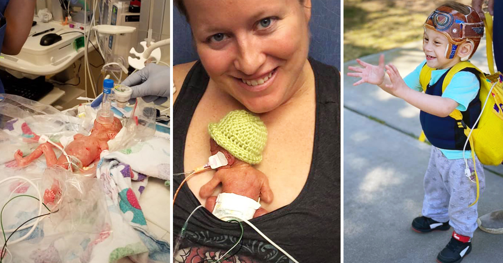 Preemie Born as Small as Coke Can Survived, Beat COVID, and Is Now a Thriving 2-Year-Old - Vimarsana News