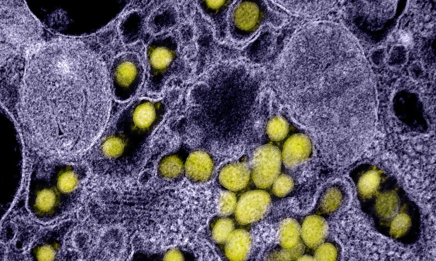 A transmission electron micrograph shows SARS-CoV-2 virus particles isolated from a patient. (NIAID)