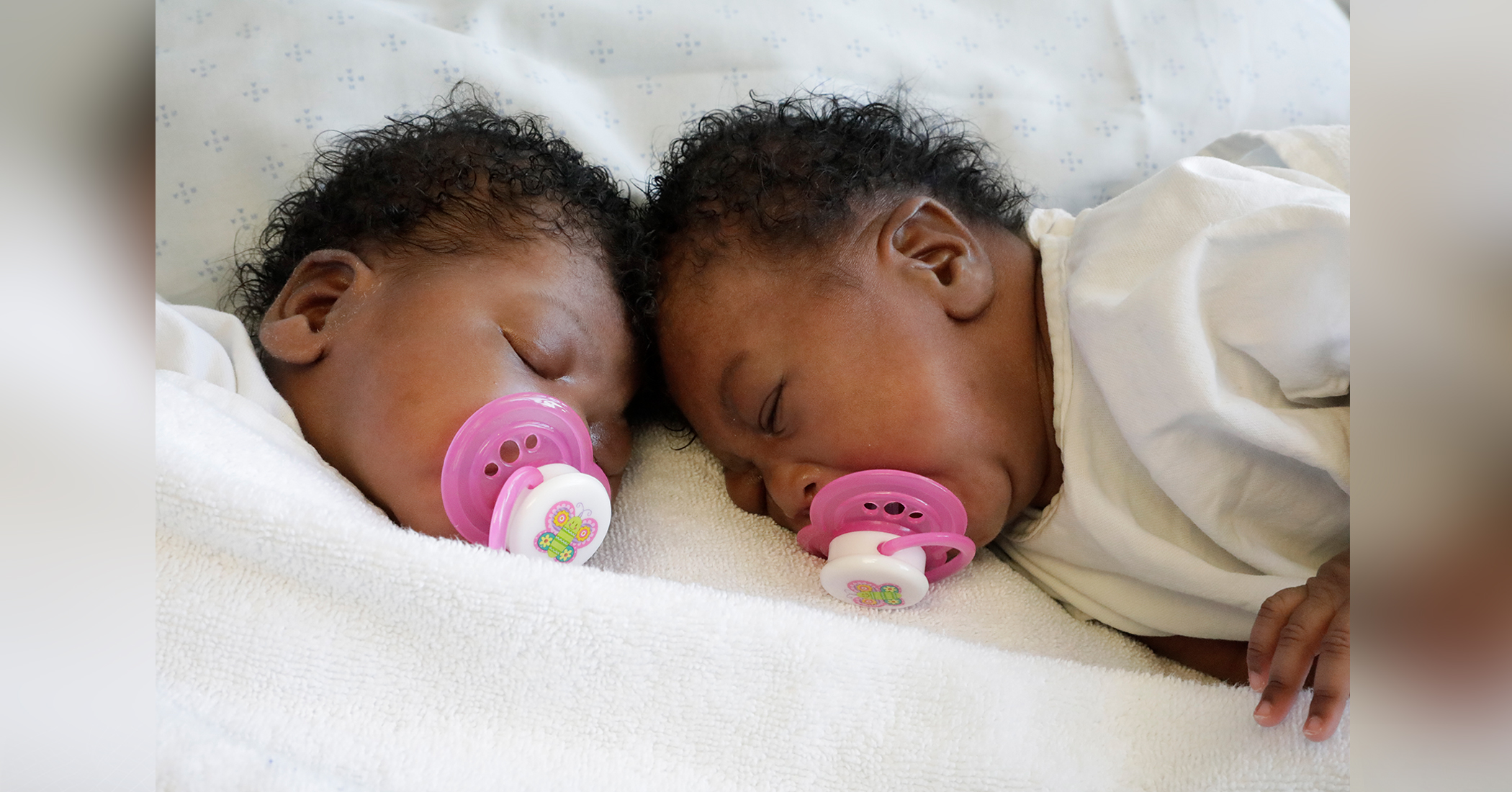 One In 25 Million Births: Twin Baby Girls Joined At The Head Are