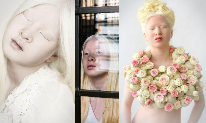 Albino Girl Abandoned by Parents in China Gets a New Life, Finds ...