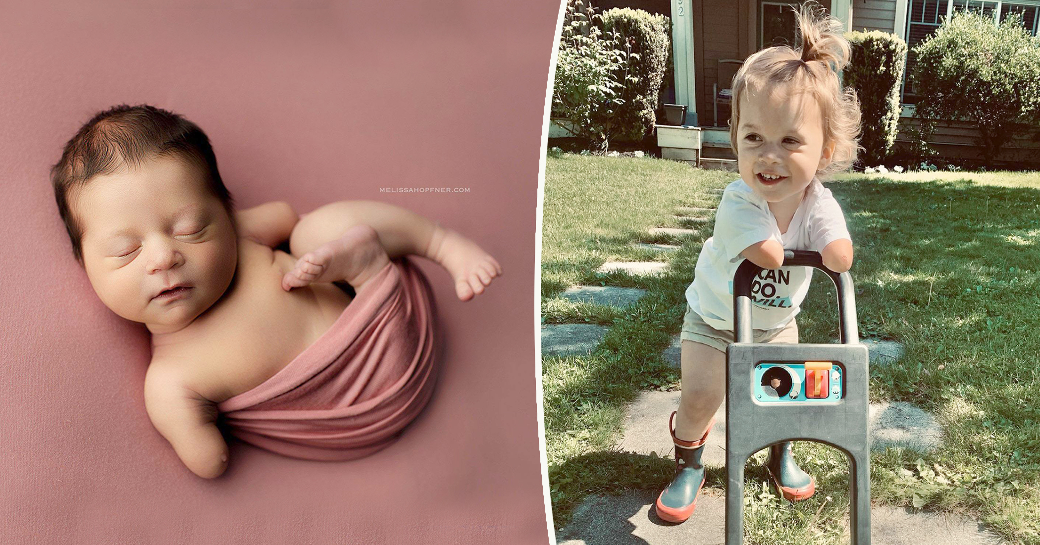 Mom of Baby Without Forearms Pens Letter to Doctor Who Advised Abortion: 'I Remember You' - Vimarsana News