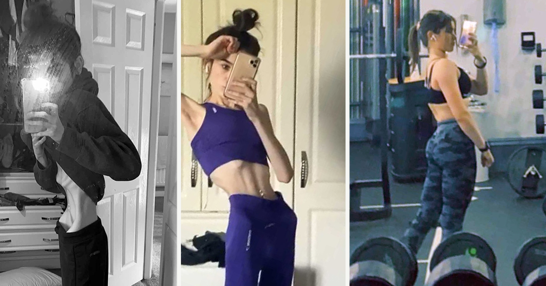 Teen With Bulimia And Anorexia Weighed Just 77lb Reclaims Life With