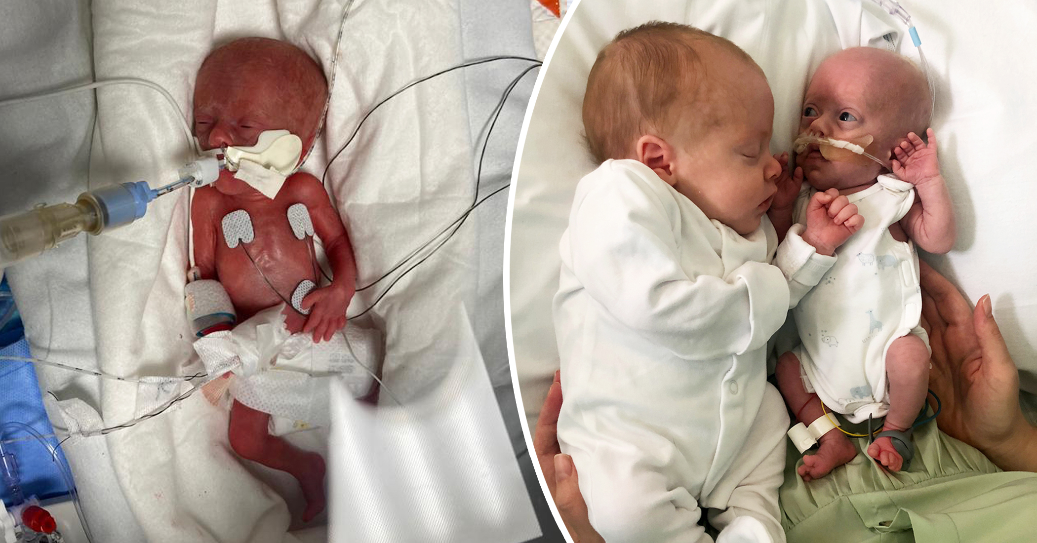 Parents Say Preemie Born Weighing 1lb Keeps 'Fighting' Due to Cuddles From Identical Twin - Vimarsana News