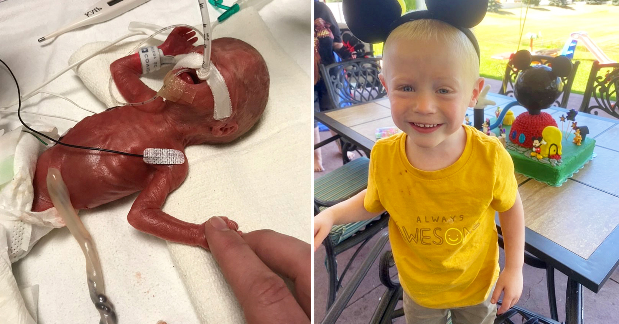 Less-Than-1lb Preemie Born a Week Before the Abortion Limit Defies the Odds to Thrive - Vimarsana News