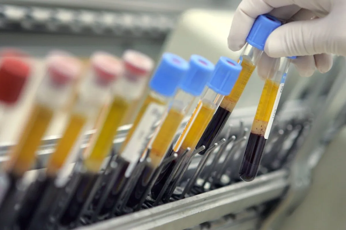 A joint team from Taiwan and the US found that demethylating drugs may induce the body to activate the SALL4 oncogene, leading to further deterioration of the disease.  This photo shows human blood samples on an automated testing line. (David Silverman/Getty Images)