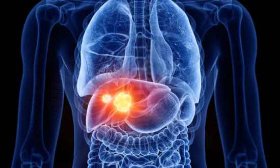 Acetaminophen Overdose Has Become a Leading Cause of Liver Failure in US