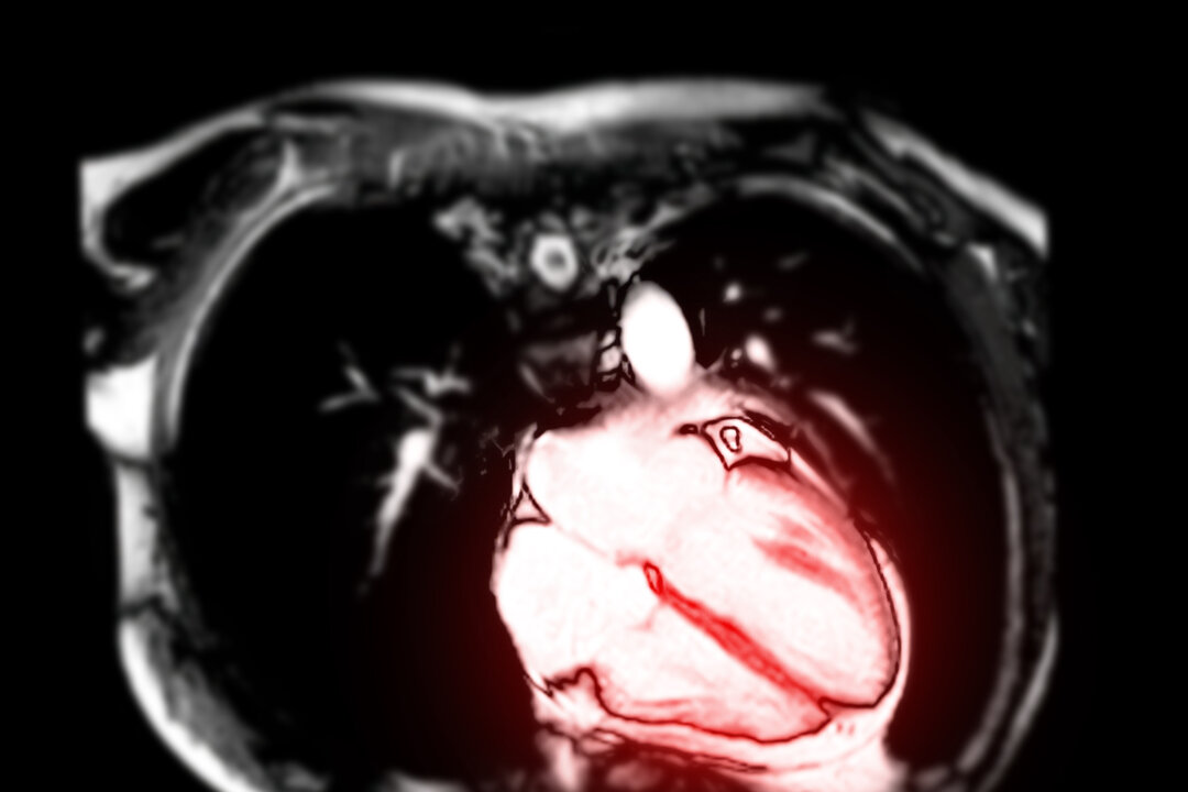 MRI Spots Heart Inflammation in Athletes Who Had COVID-19