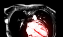 MRI Spots Heart Inflammation in Athletes Who Had COVID-19