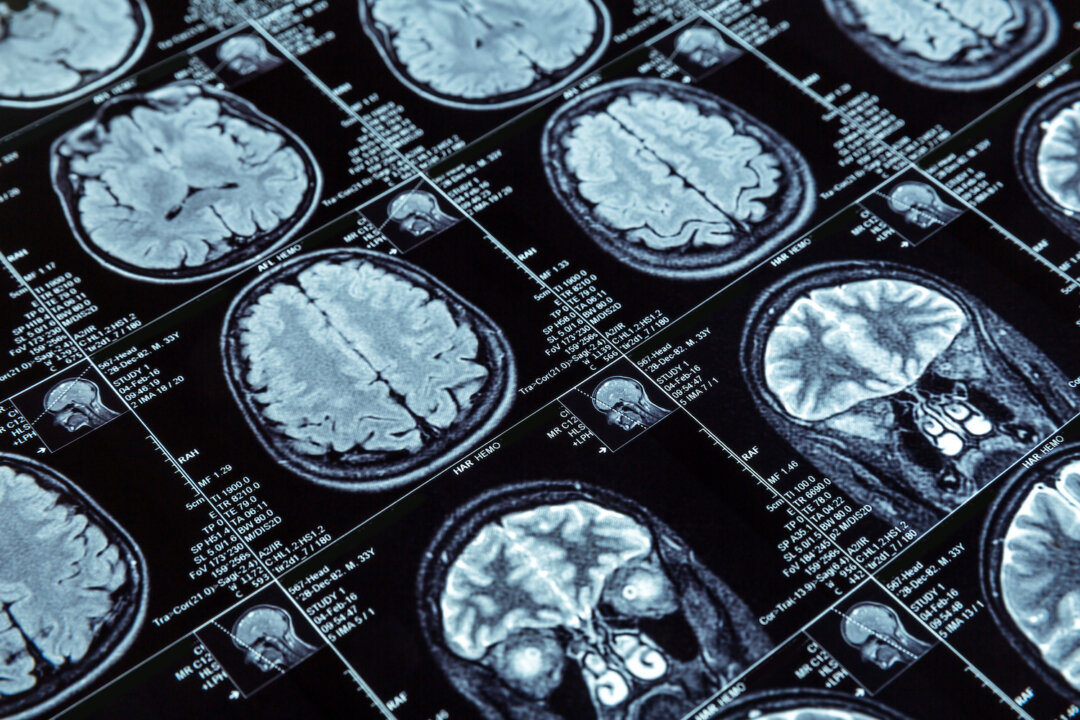 Link Between Sugar and Alzheimer’s Strengthens