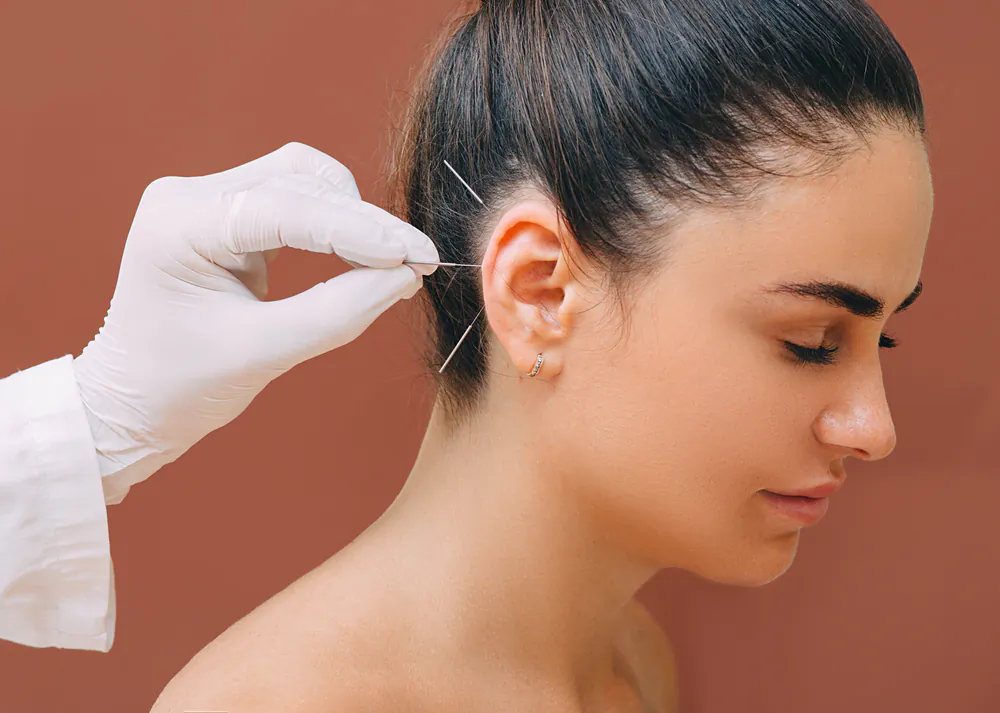 Acupuncture has been around for approximately 3000 years in Traditional Chinese Medicine. (Shutterstock)