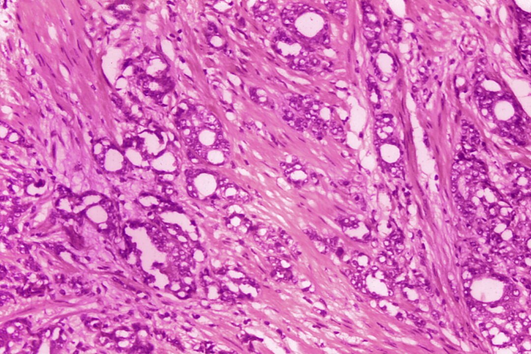 Changes in cells indicative of adenocarcinoma of the prostate in a 1974 microscope image. (Dr. Edwin P. Ewing, Jr./CDC via AP)