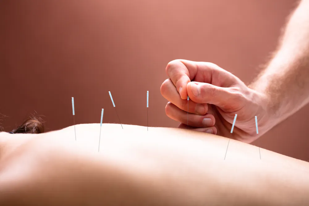 When needles are inserted into the acupoints of the human body, they strengthen the circulation of qi and blood, overcome the blockage of the meridians, restore the meridian system to normalcy, and thus cure the disease.(Shutterstock)