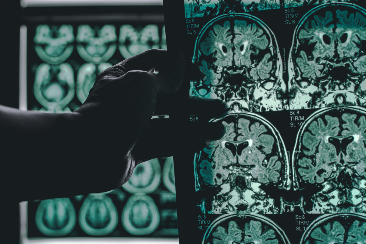 Brain scans of a patient with Alzheimer's disease (Atthapon Raksthaput/Shutterstock)