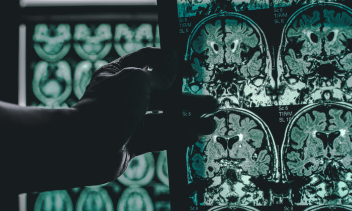 Brain scans of a patient with Alzheimer's disease (Atthapon Raksthaput/Shutterstock)