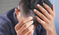 Study Links COVID-19 Infection to Excessive Hair Loss