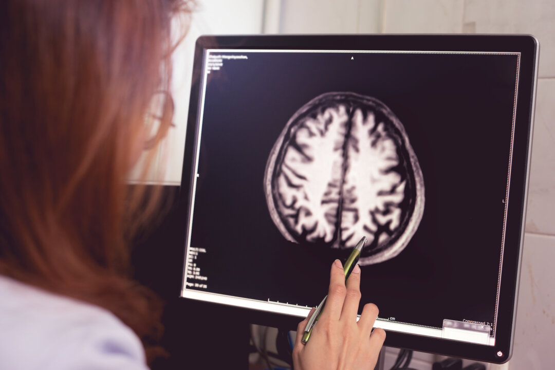 MRI brain of a dementia patient with left parietal atrophy asymmetry. (Atthapon Raksthaput/Shutterstock)