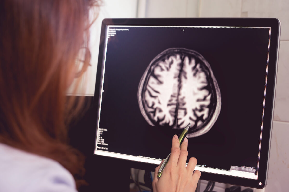 MRI brain of Dementia patient with left parietal atrophy asymmetry. (Atthapon Raksthaput/Shutterstock)