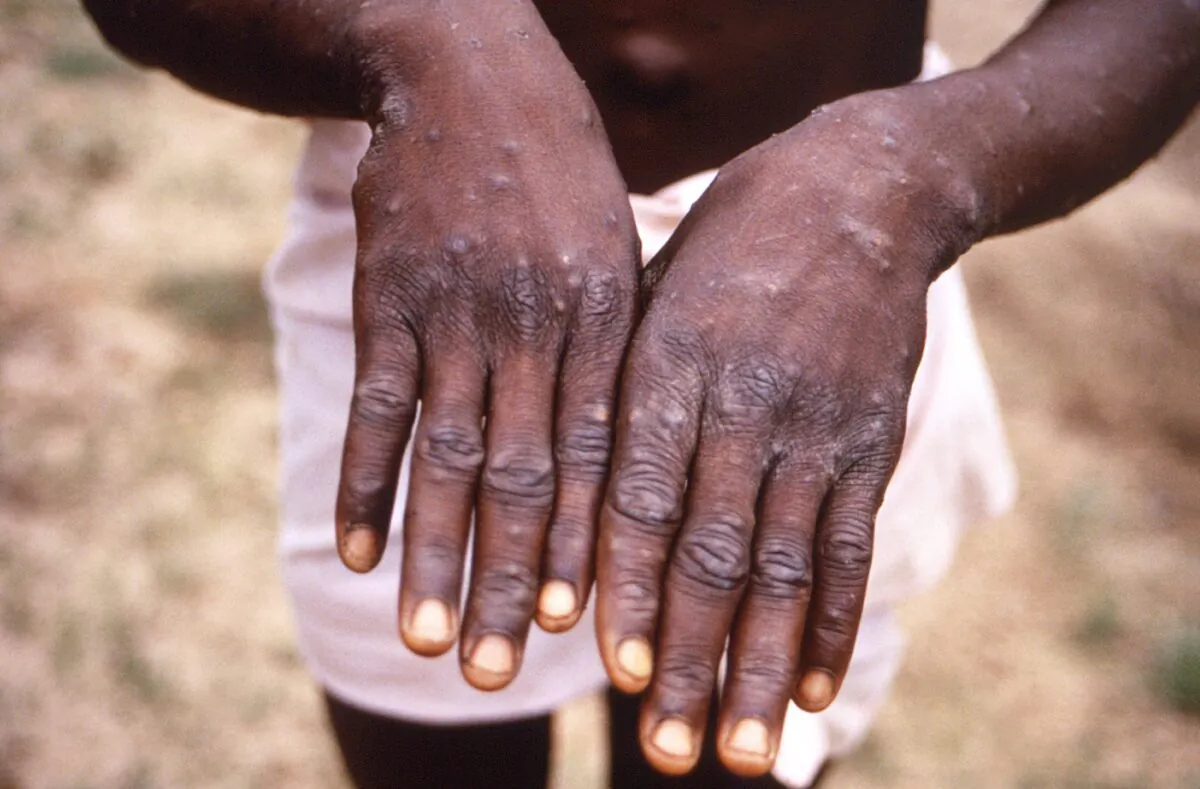 A 1997 image of the hands of a monkeypox case patient in the Democratic Republic of the Congo (DRC), formerly Zaire. (CDC via AP)