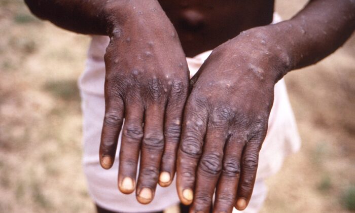 A 1997 image of the hands of a monkeypox case patient in the Democratic Republic of the Congo (DRC), formerly Zaire. (CDC via AP)