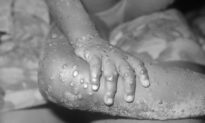 Canada’s First 2 Cases of Monkeypox Confirmed in Quebec as More Cases Reported Worldwide