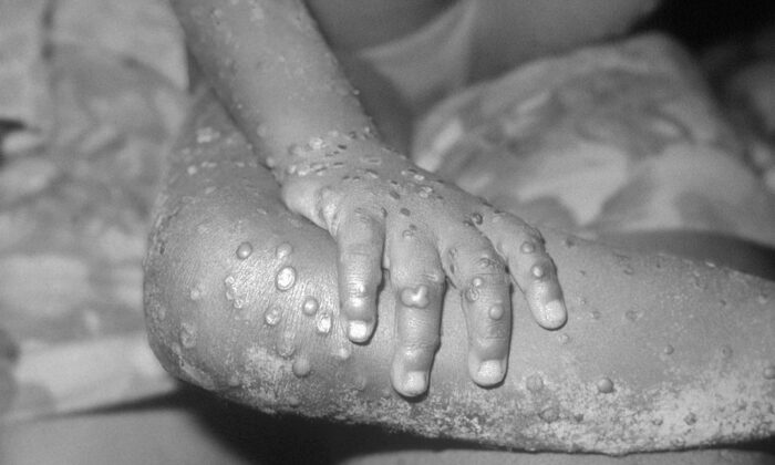 A 1971 photo from the Center For Disease Control handout shows monkeypox-like lesions on the arm and leg of a female child in Bondua, Liberia.  (CDC/Getty Images)