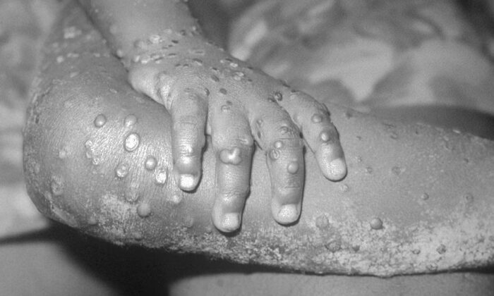 A 1971 photo from the Centers for Disease Control and Prevention shows monkeypox-like lesions on the arm and leg of a female child in Bondua, Liberia. (CDC/Getty Images)