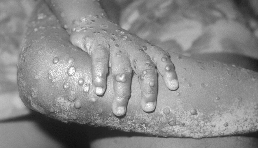 A 1971 photo from the Center For Disease Control handout shows monkeypox-like lesions on the arm and leg of a female child in Bondua, Liberia. (CDC/Getty Images)