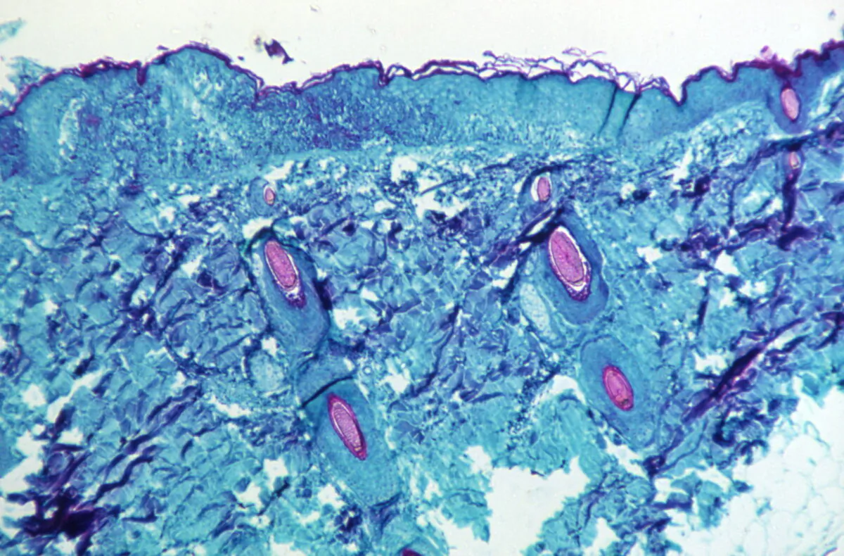 A section of skin tissue, harvested from a lesion on the skin of a monkey, that had been infected with monkeypox virus, is seen at 50X magnification on day four of rash development in 1968. (CDC/Handout via Reuters)