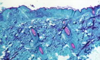 Monkeypox Will Get a New Name: WHO