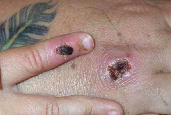 Monkey Pox Lesions