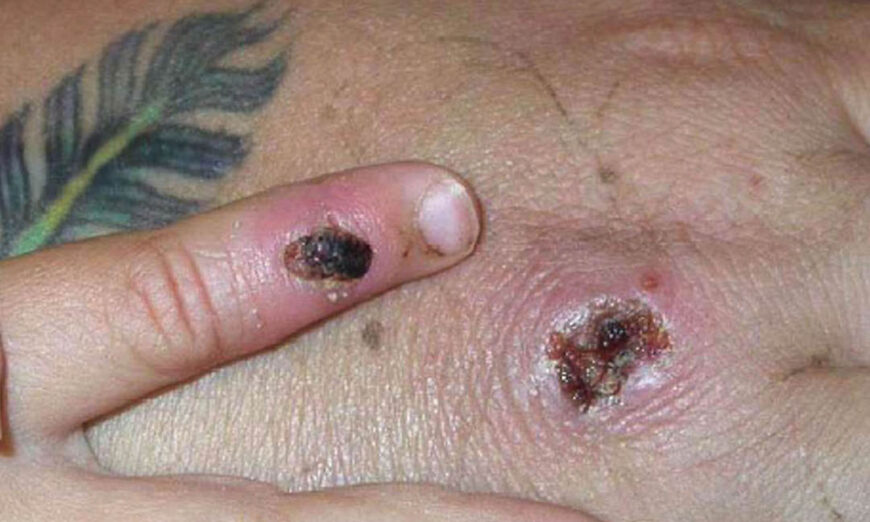 Symptoms of one of the first known cases of the monkeypox virus are shown on a patient's hand June 5, 2003. (CDC/Getty Images)