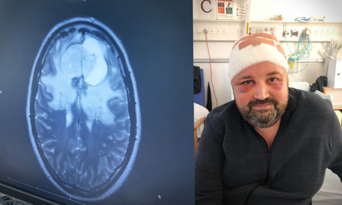 Man’s Headaches Turn Out to Be 2 Fused Tumors in His Brain, Dubbed ‘Walking Miracle’ After Recovery