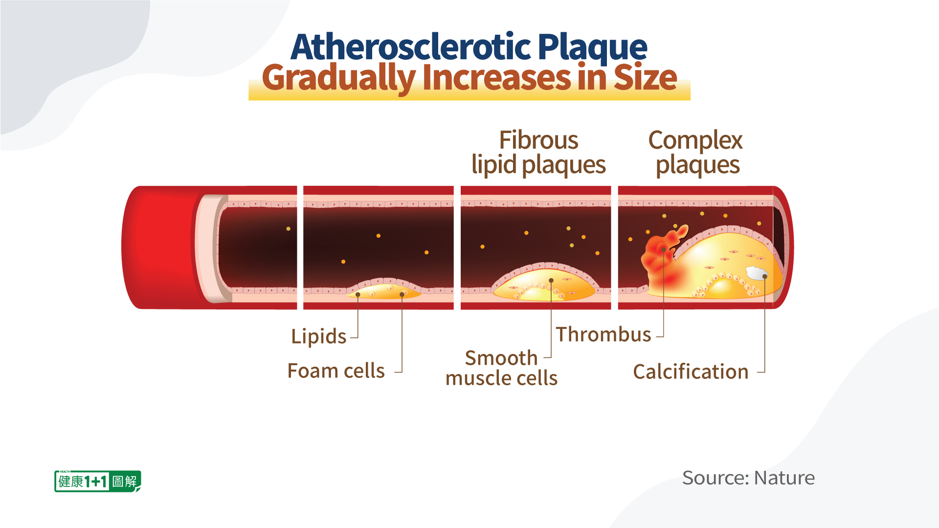 You Can Reverse Atherosclerosis and Prevent Heart Attacks If Your ‘Bad