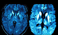 Deadly Prion Brain Diseases & COVID Vaccines: Study Finds Plausible Link