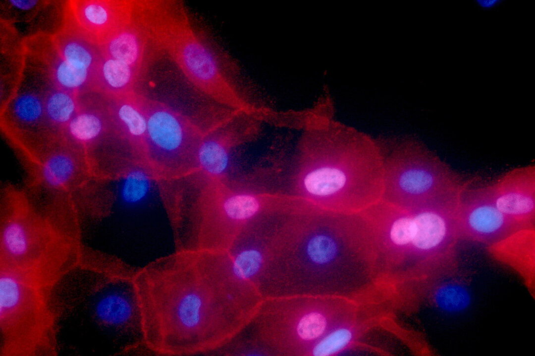A culture of human breast cancer cells, in an undated fluorescence-colored microscope image made available by the National Institutes of Health in September 2016. (Ewa Krawczyk/National Cancer Institute via AP)