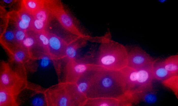 A culture of human breast cancer cells, in an undated fluorescence-colored microscope image made available by the National Institutes of Health in September 2016. (Ewa Krawczyk/National Cancer Institute via AP)