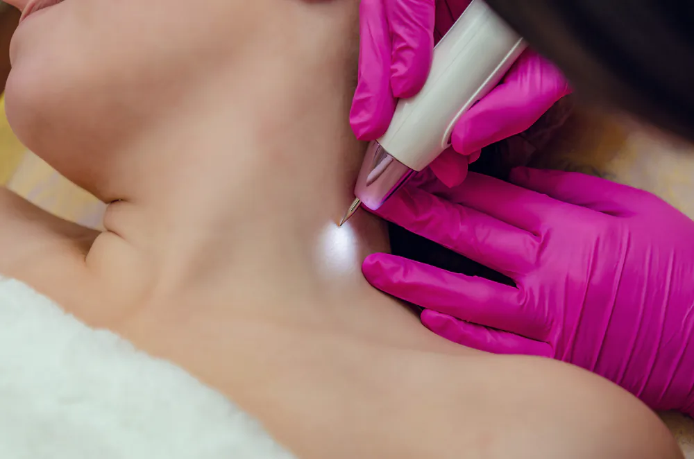 Skin tags are mostly skin and collagen, but they’re also connected to us through a few blood vessels. (ShutterStock)