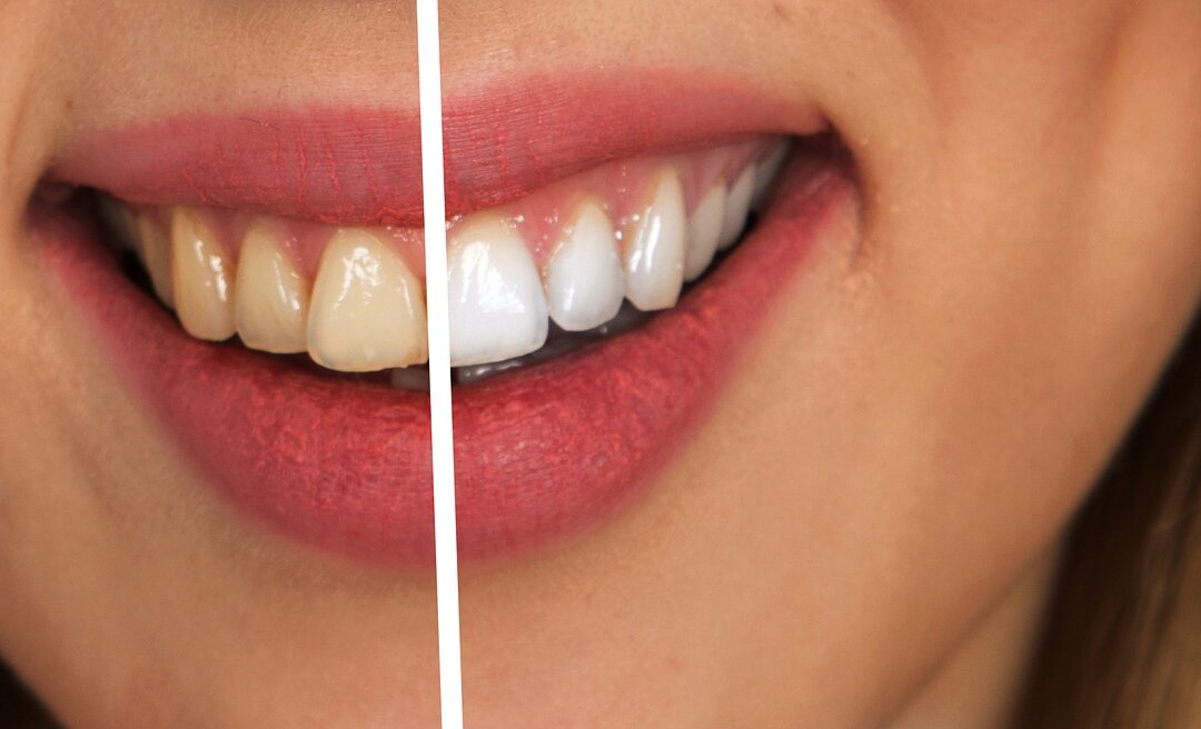 Tooth Whitening. (Gerd Altmann)