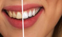 Ask a Dentist: Tooth Whitening