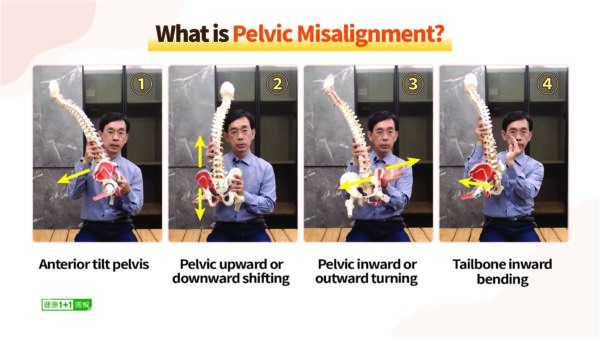 7 Tips to Quickly Correct Pelvic Misalignment