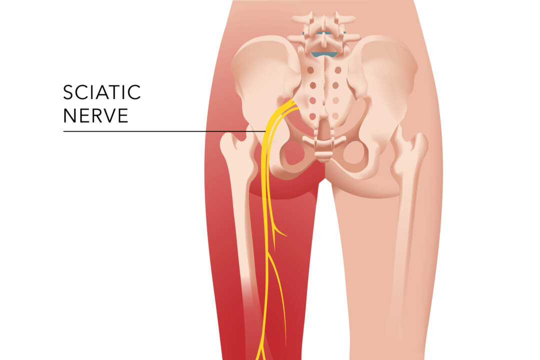 Sciatica is a painful condition that up to 40 percent of Americans will develop at some point in their lives. Fortunately, it can be prevented and cured naturally. (Mari C/Shutterstock)