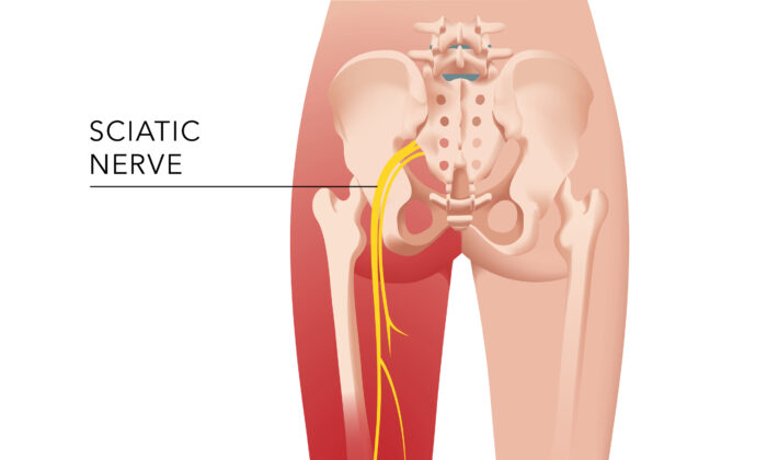 How I Healed My Sciatica