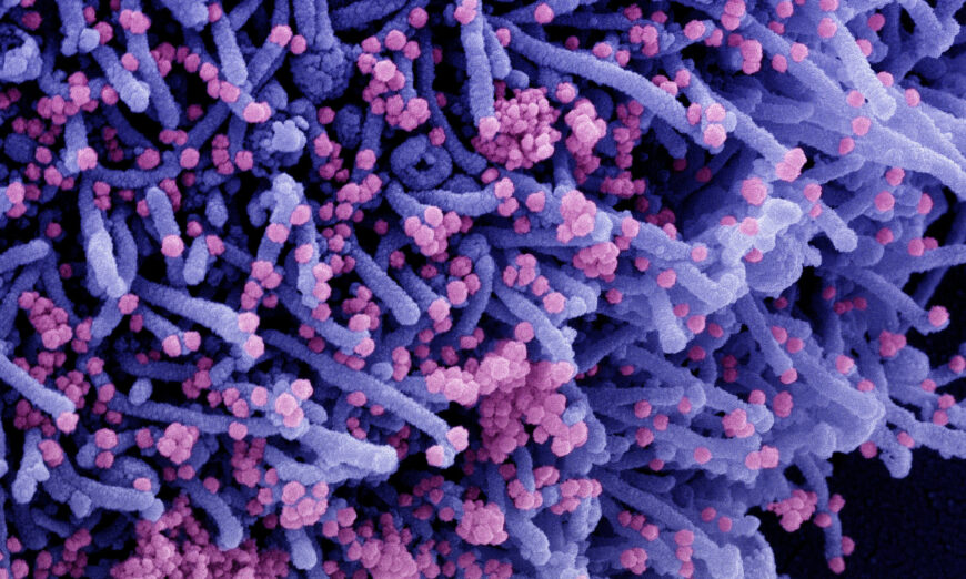 Colorized scanning electron micrograph of a cell (purple) infected with a variant strain of SARS-CoV-2 virus particles (pink), isolated from a patient sample. (NIAID via The Epoch Times)