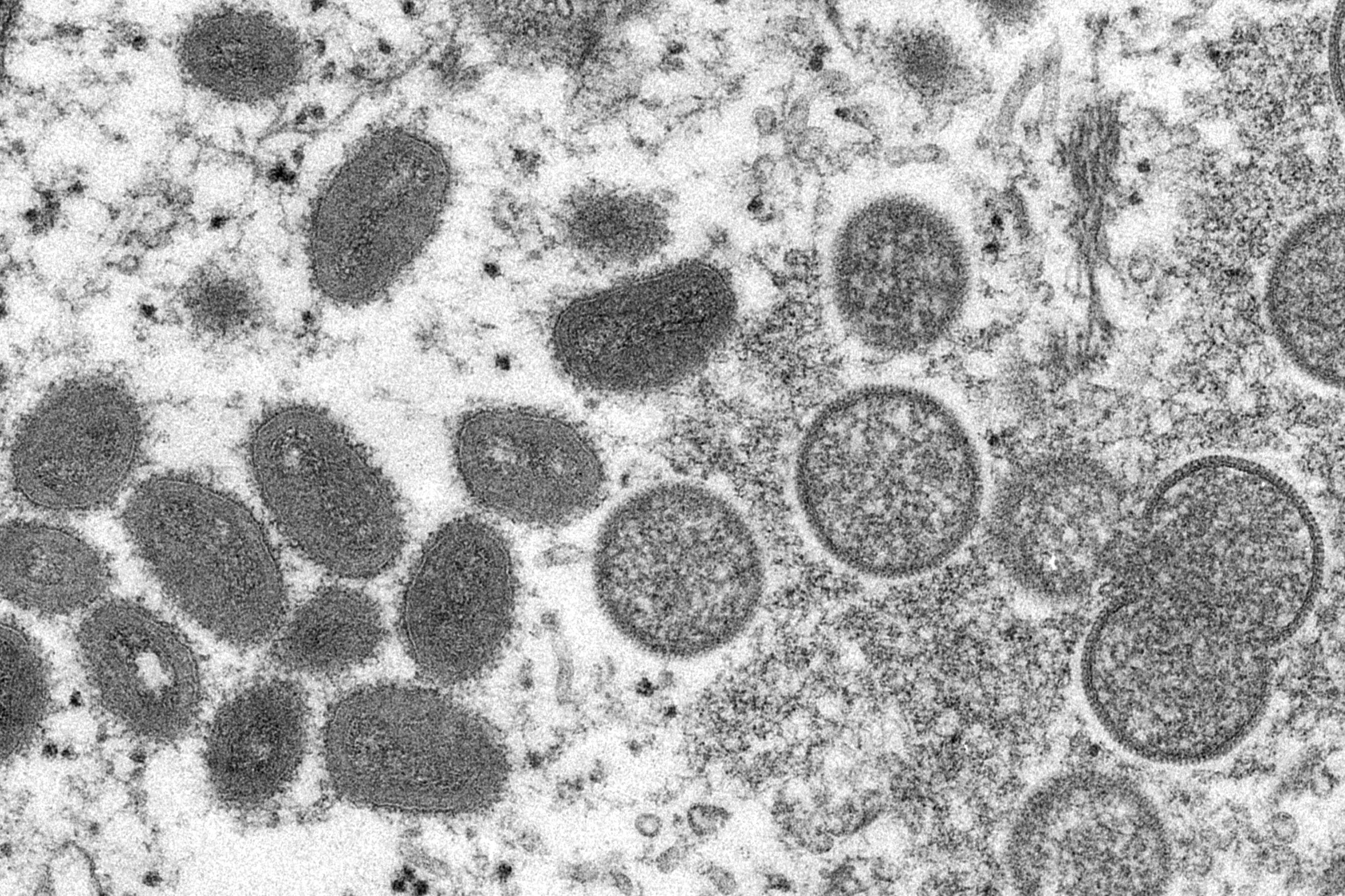 Monkeypox Alert Issued By CDC Over New Cases in Major US City - Vimarsana News