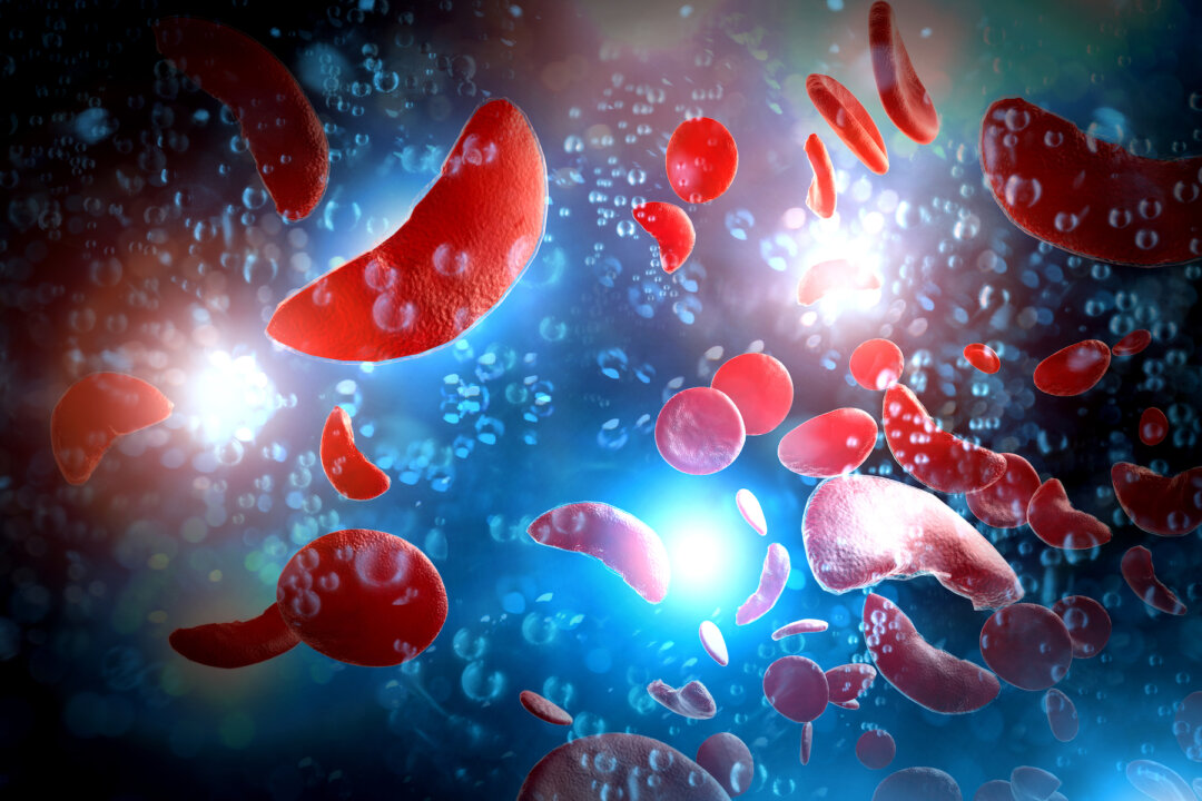 Abnormal hemoglobin, the protein that enables red blood cells to carry oxygen, causes sickle cells to acquire their crescent shape and rigidity (Ezume Images/Shutterstock)