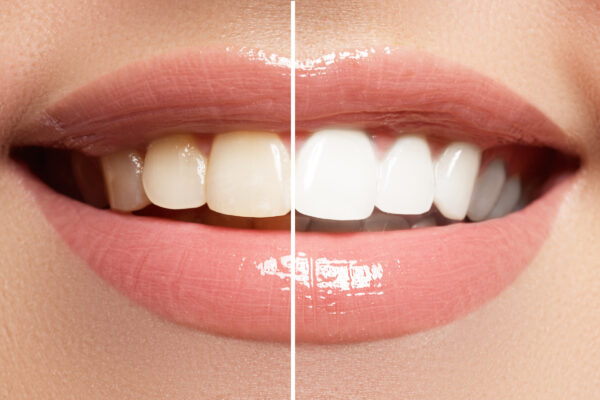 Natural Ways to Whiten Your Teeth at Home