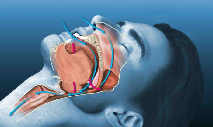 What Is Sleep Apnea?