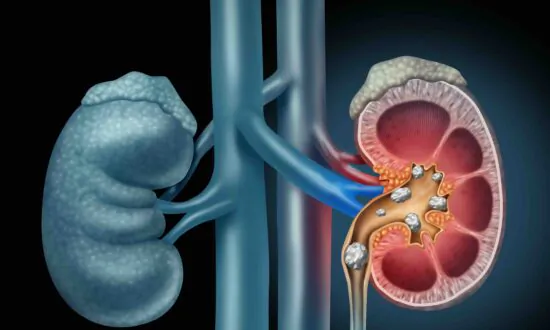 A Particular Bacterium in Your Urine Can Help Protect Against Kidney Stones